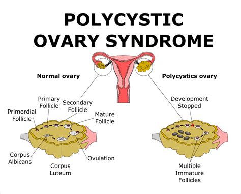 polycystic ovarian syndrome disease